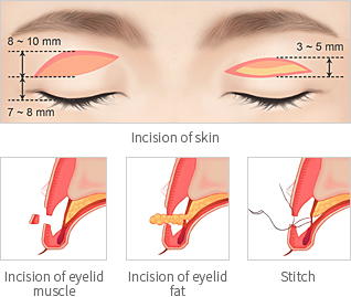 Double-Eyelid-Surgery4