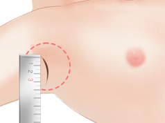 Breast-Augmentation-with-Implants-7b