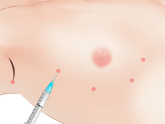 Breast-Augmentation-with-Implants-7c