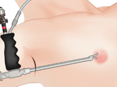 Breast-Augmentation-with-Implants-7d