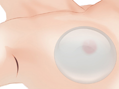 Breast-Augmentation-with-Implants-7e