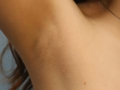 Breast-Augmentation-with-Implants-7f