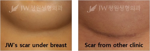 Breast-Augmentation-with-Implants-9-1
