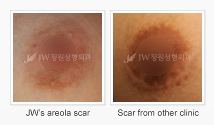 Breast-Augmentation-with-Implants-scar-jw