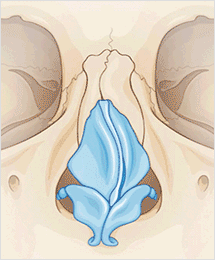 Corrective-rhinoplasty-for-deviated-nose-correction-2-1