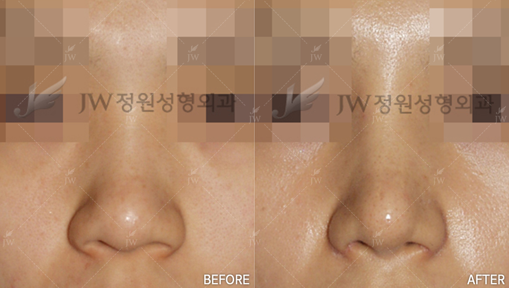 Nose Surgery - Rhinoplasty, Tip Plasty, Alar Reduction (B) - JW Thai