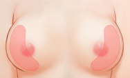 breast4_img1e