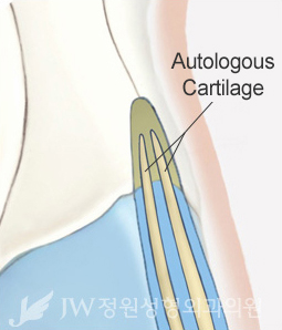 hump-nose-surgery-korea-2
