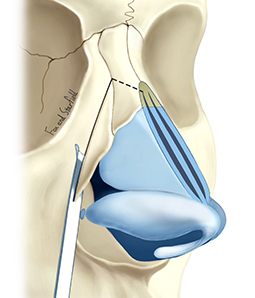 lateral-osteotomy