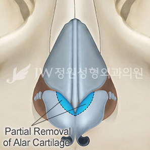 long-nose-correction