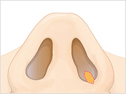 nose9_img2