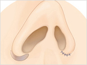 nose9_img4