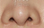 nose_img5_1