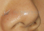 nose_img5_2
