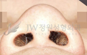 nose_img5_3